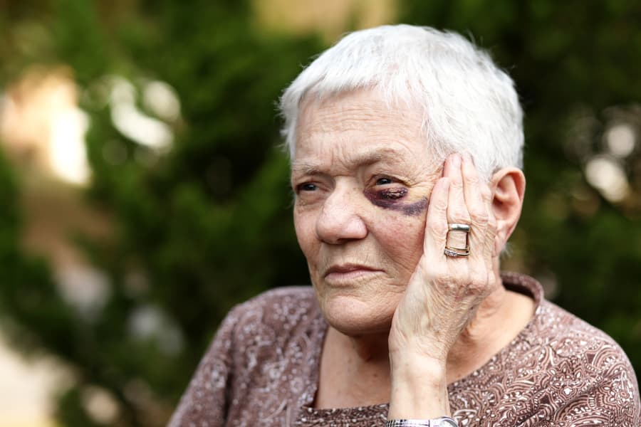 elderly woman with black eye holding her face