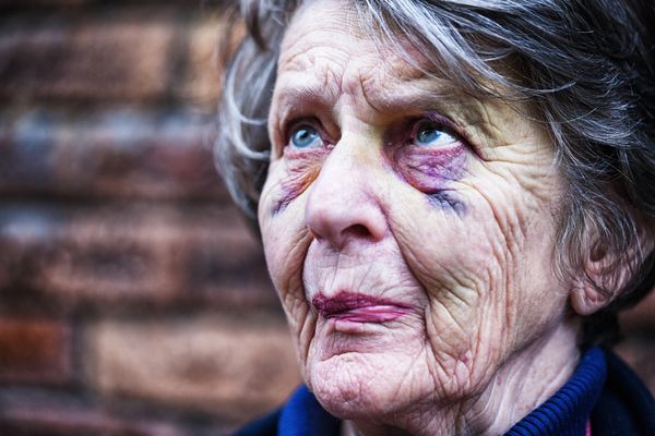 A senior woman with two black eyes, looking nervous